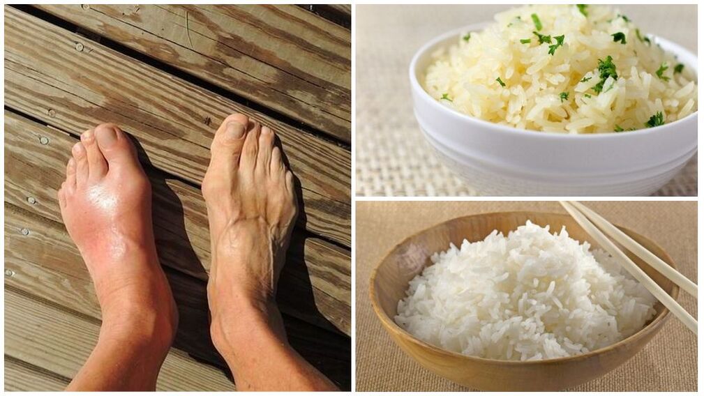 A rice-based diet is recommended for gout patients. 